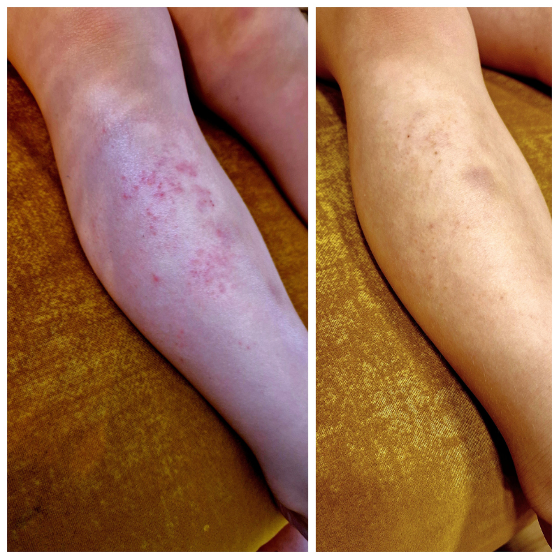 Elave giliai drėkinančio tepalo naudojimo rezultatas atopiniu dermatitu sergančio vaiko odai