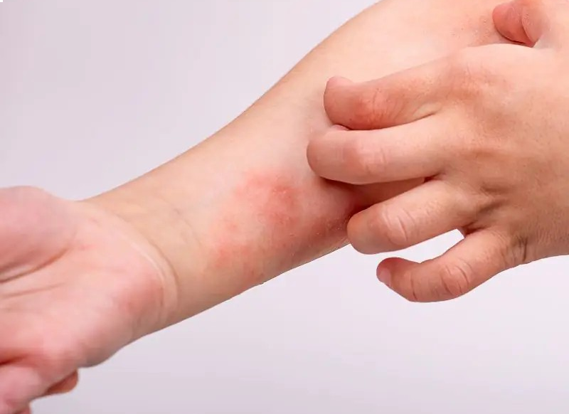 Sausa, niežtinti ir pleiskanojanti oda: priežastys ir priežiūra | Kidsmed