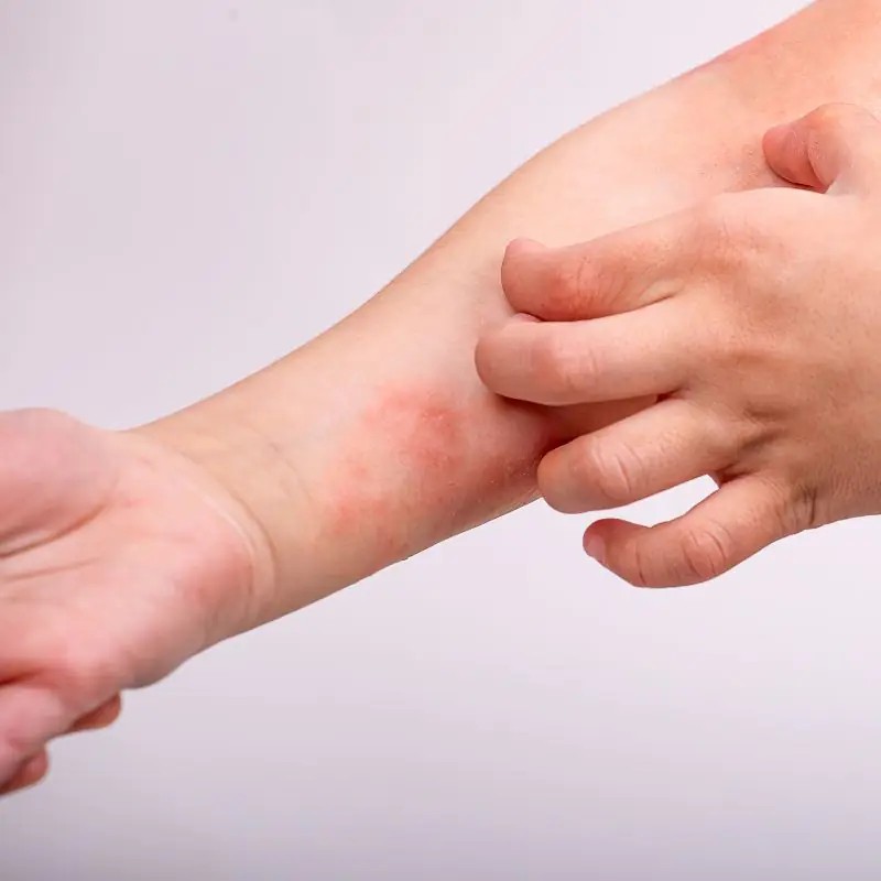 Sausa, niežtinti ir pleiskanojanti oda: priežastys ir priežiūra | Kidsmed