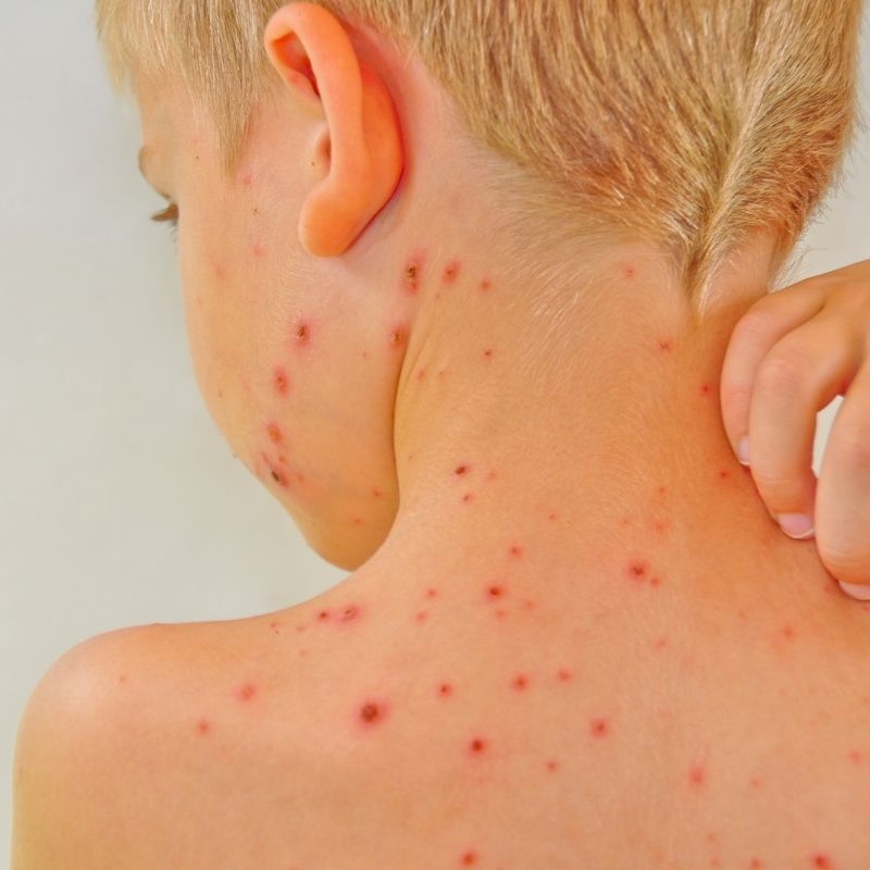 Vėjaraupiai vaikui: ką naudoti palengvinimui ir kalamino nauda | Kidsmed